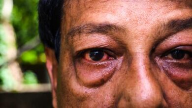 Man Loses Eyesight After Using Urine to Treat Conjunctivitis