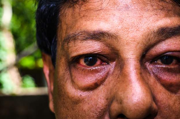 Man Loses Eyesight After Using Urine to Treat Conjunctivitis
